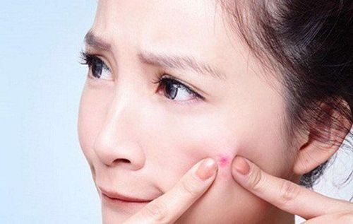 Is squeezing acne good?