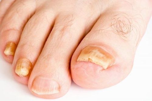 
Nấm móng chân là do nhóm nấm dermatophyes gây ra
