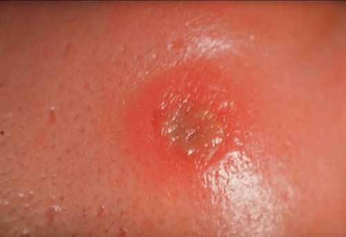 
Bệnh giang mai giai đoạn đầu cần được thực hiện xét nghiệm Syphilis
