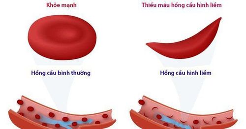 
Bệnh hồng cầu hình liềm là một loại bệnh thiếu máu di truyền
