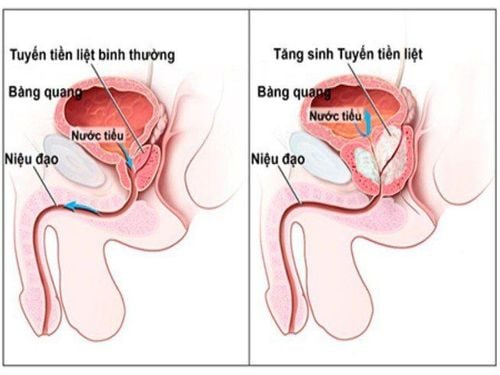 
Tuyến tiền liệt là một phần của hệ thống sinh sản của nam giới
