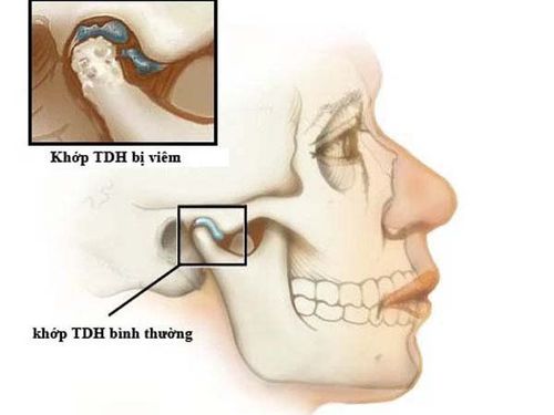 Viêm khớp nhai uống thuốc không đỡ phải làm sao?