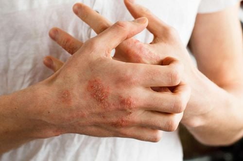 Latex allergy: Symptoms and treatment