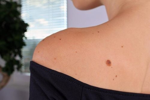 Atypical, Unusual and Irregular Moles: Is Your Mole Normal?