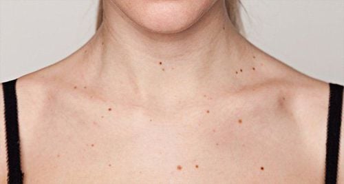 What is an atypical mole?