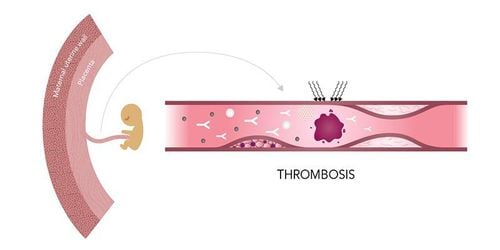 Antiphospholipid syndrome (APS) in pregnant women