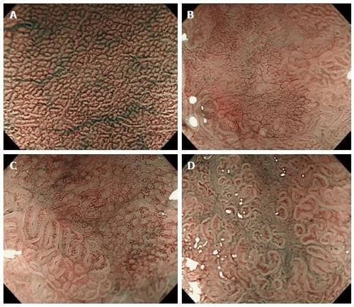 
Mô hình MV (Microvascular) và MS (Microsurface): Hình ảnh một tổn thương ung thư sớm ở dạ dày, với đường ranh giới (Dermacation line), bất thường vi bề mặt (Microsurface) và vi mạch máu (Microvascular)
