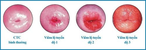 Viêm lộ tuyến cổ tử cung kích thước 0,7cm nên điều trị thế nào?