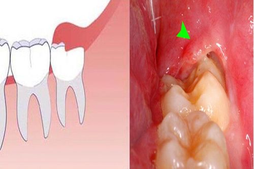 Mọc răng khôn hàm dưới gây đau khi nhai thức ăn có cần nhổ không?