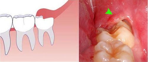 Viêm lợi trùm có điều trị dứt điểm được không?