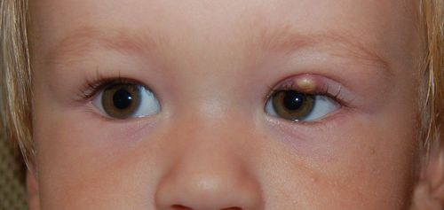 Điều trị sẹo lồi vùng mi mắt do muỗi đốt cho trẻ 11 tháng như thế nào?