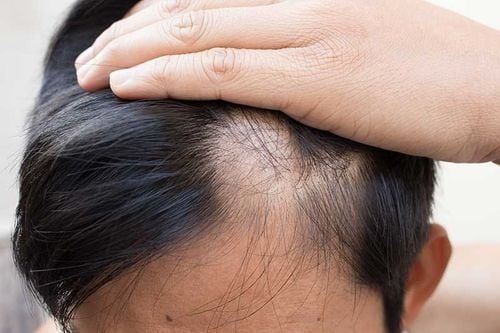 What is scarring alopecia?