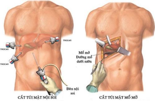 Gallbladder stone surgery for nearly 2 years, pain, indigestion, vomiting, what medicine should I take?