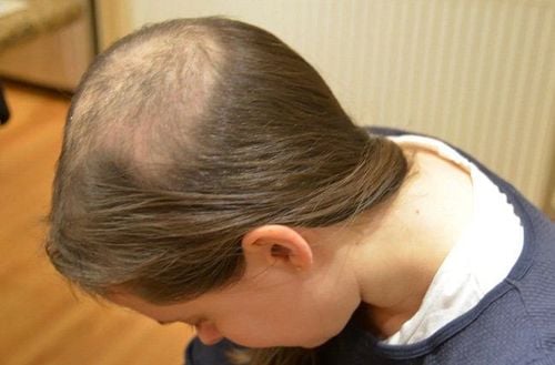 
Nguyên nhân rụng tóc có thể do trẻ mắc bệnh lý trichotillomania.
