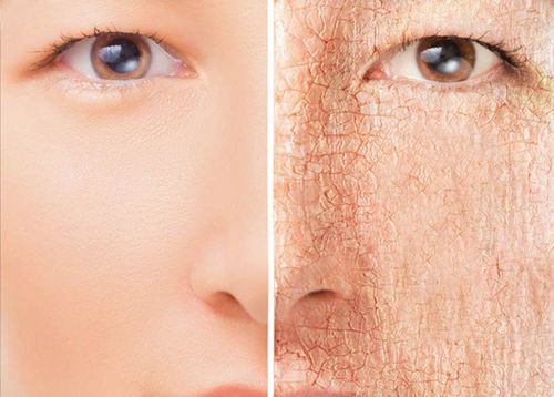 Symptoms of dehydrated skin