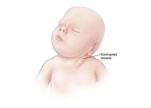 Exercises to cure torticollis for babies