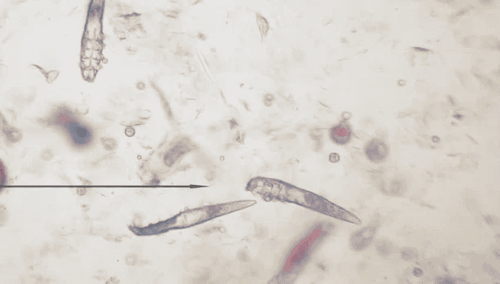 
Demodex soi tươi là xét nghiệm cho phép phát hiện bệnh Demodex ở người
