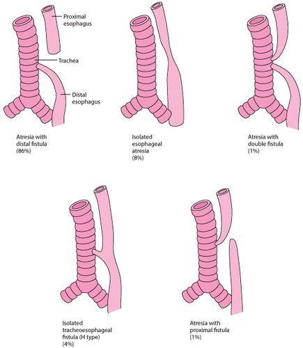 
Nguyên nhân thở khò khè do các type rò khí thực quản
