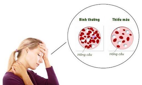 
Thiếu máu thiếu sắt là một trong những nguyên nhân gây rụng tóc
