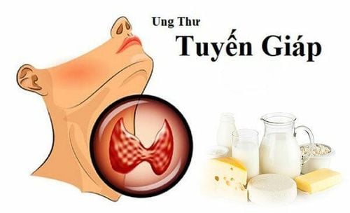 Chế độ ăn cho người sau điều trị ung thư tuyến giáp?