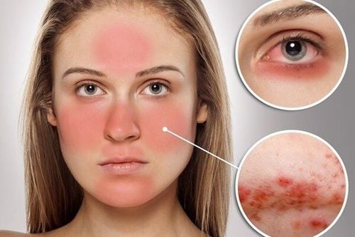 
Xét nghiệm ANA để chẩn đoán bệnh lupus ban đỏ
