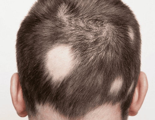 Alopecia areata causes