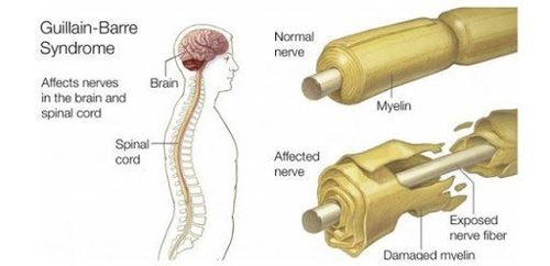 How should Guillain-Barre Syndrome be treated?