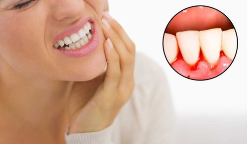 Bleeding gums: What you need to know