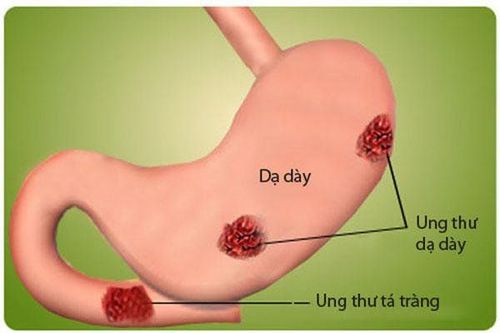 
Ung thư dạ dày chủ yếu ảnh hưởng đến những người lớn tuổi
