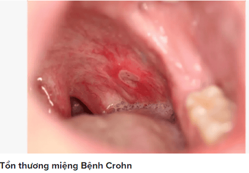 
Hình ảnh tổn thương miệng ở bệnh Crohn
