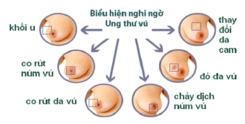 
Các dấu hiệu ung thư vú có thể nhận biết
