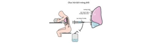 What are the risks of pleural aspiration and pleural biopsy?