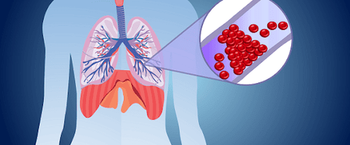 Tại sao tắc động mạch phổi lại có thể giết bạn?