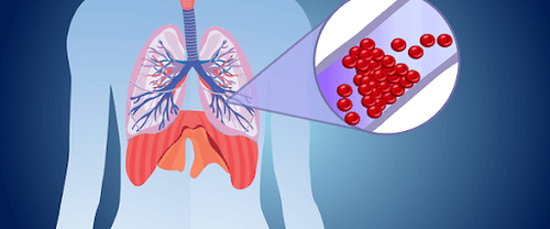 Why can a pulmonary embolism kill you?