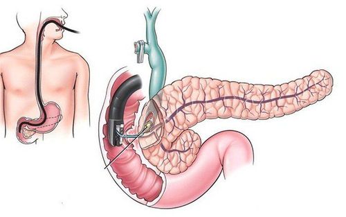 
Siêu âm nội soi có vai trò quan trọng trong chẩn đoán viêm tụy tự miễn
