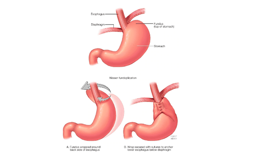 
Phẫu thuật tạo hình phình vị dạ dày trong điều trị trào ngược: Tạo ra một van nhân tạo ở chỗ nối thực quản dạ dày.
