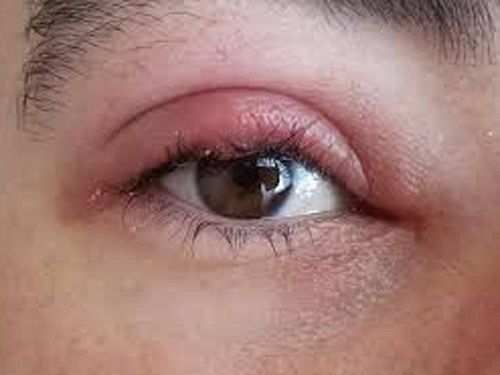 Tại sao bị đau bọng mắt và phương pháp điều trị thế nào?