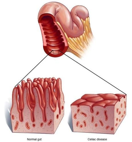 
Bệnh nhân bị bệnh celiac có thể gặp tình trạng thiếu Vitamin D
