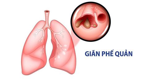 Causes, symptoms and treatment of bronchiectasis