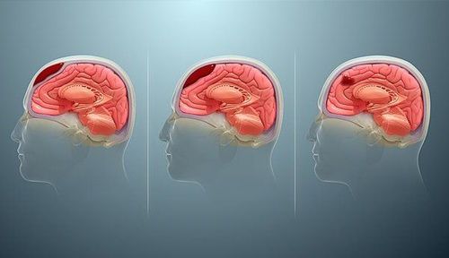 Intracranial hematoma is diagnosed by what medical technique?