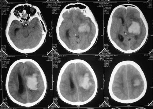 
CT scan được sử dụng trong chẩn đoán tụ máu nội sọ
