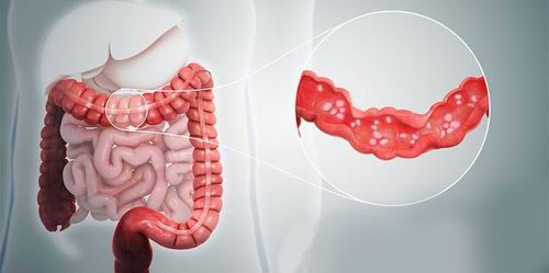 Diagnosis of ischemic colitis by any medical technique?