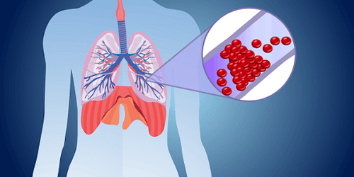 By what medical technique is a pulmonary infarction diagnosed?