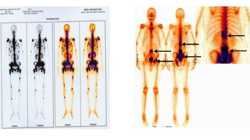 Does bone scan require fasting?