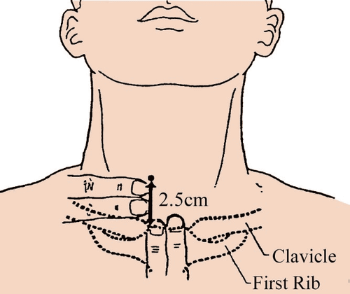 
Bệnh nhân thực hiện phong bế hạch sao nằm ngửa với gối kê ở dưới vai để cổ được duỗi thẳng
