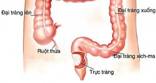 Dấu hiệu bục chỉ vết mổ và cách vận động phù hợp sau mổ trực tràng thấp