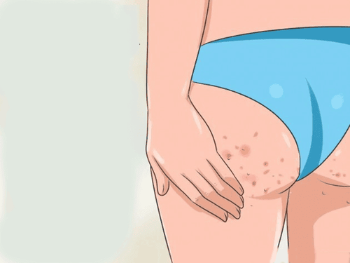 Nổi mụn đỏ ở mông là dấu hiệu bệnh gì?