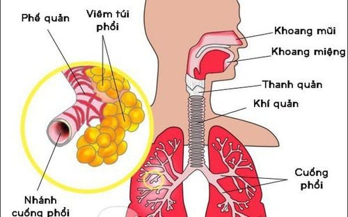 Trẻ có bệnh tim đi hồ bơi có nguy cơ bị tái phát viêm phế quản cấp không?