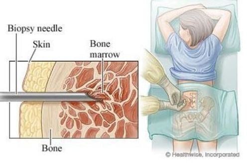 
Sinh thiết tủy xương và chọc hút tủy xương

