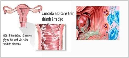 Nhiễm nấm phụ khoa khi mang thai thời gian đầu phải làm gì?